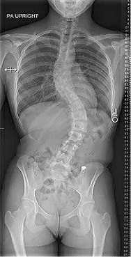 Adolescent Idiopathic Scoliosis Lenke Type 3|best spine clinic in pune