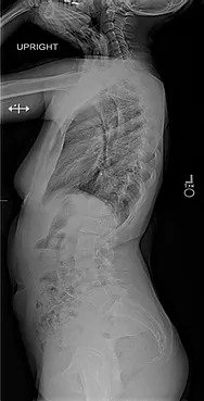 Adolescent Idiopathic Scoliosis|Scoliosis treatment in Pune | Abnormal spine curvature treatment