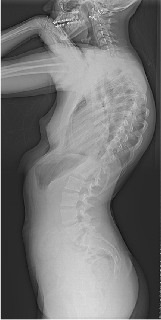 Adolescent Idiopathic Scoliosis|Scoliosis treatment in Pune | Abnormal spine curvature treatment