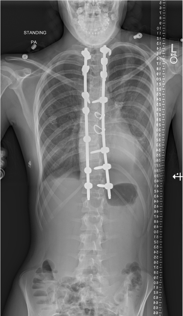 Posterior Spinal deformity correction and instrumented fusion surgery|Pune Spine Institute|Spine clinic in pune