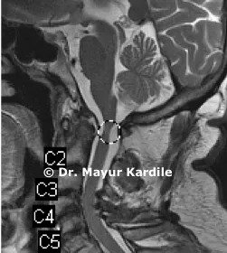 best spine centre in pune, scoliosis clinic in Pune,  spine facility in Pune