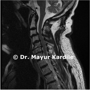 Cervical Myelopathy|Spine surgery in Pune