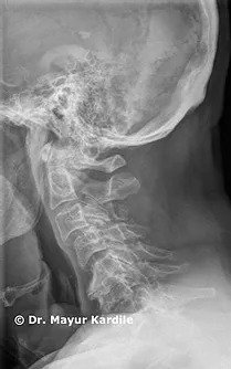 Kyphosis treatment in Pune | Spinal bones treatment | Spinal bones treatment in Pune
