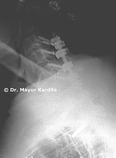 Kyphosis treatment in Pune | Spinal bones treatment | Spinal bones treatment in Pune