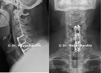 Anterior Cervical Discectomy | Corpectomy and Fusion | Spine Treatment In Pune