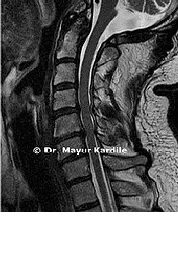 ACDF for Cervical Radiculopathy|Anterior Cervical Discectomy in Pune | Corpectomy and Fusion in Pune