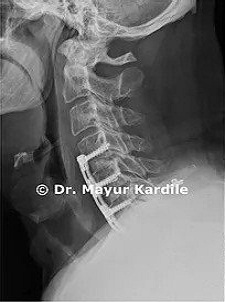 ACDF for Cervical Radiculopathy|Spine surgery in Pune 