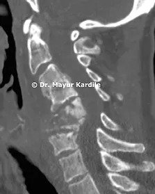 Cervical Spine Infection |Spine surgery in Pune 
