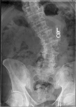 Flat back deformity treatment in Pune | Flat back syndrome treatment | Lumbar spine treatment in Pune | Sagittal imbalance surgery in Pune 