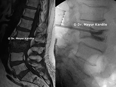 L3 Metastatic Tumor Vertebroplasty|Spine tumors surgery in Pune | Spine tumor removal surgery | Spine surgery in Pune