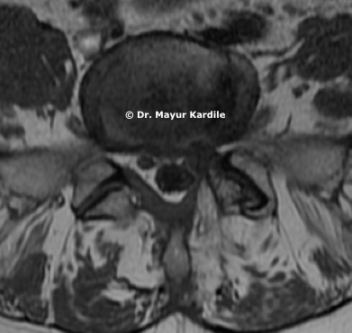 Recurrent disc hernaition with Formainal stenosis|Spine surgery in Pune | 