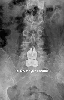 best spine centre in pune, scoliosis clinic in Pune,  spine facility in Pune