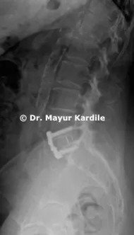 Spine care in pune,  best spine clinic in pune,