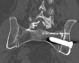 Sacroiliac joint Fusion|Minimally invasive SI joint fusion in Pune | SI joint fusion | SI joint fusion in Pune