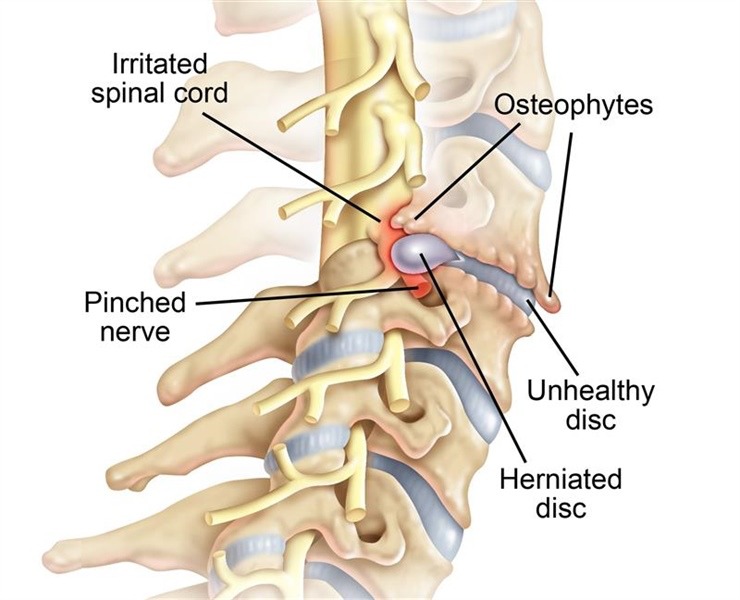 Herniated Disc condition